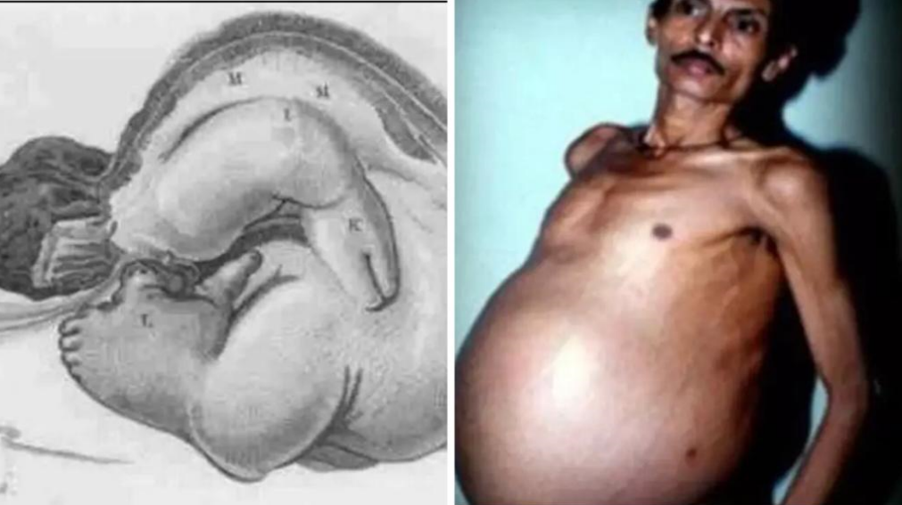 Pregnant Looking Man Had His Twin Living Inside Him For Over 36 Years