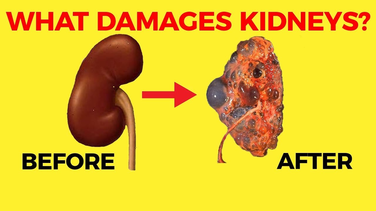 HEALTH: These 10 Habits may Damage your Kidneys and help to cause