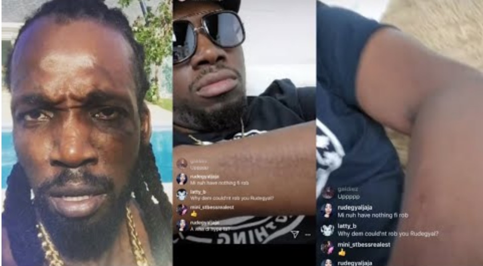 Foota Hype Talks Getting a Broken Hand For Being Loyal to Mavado.. Also got Stab-up Over Girl
