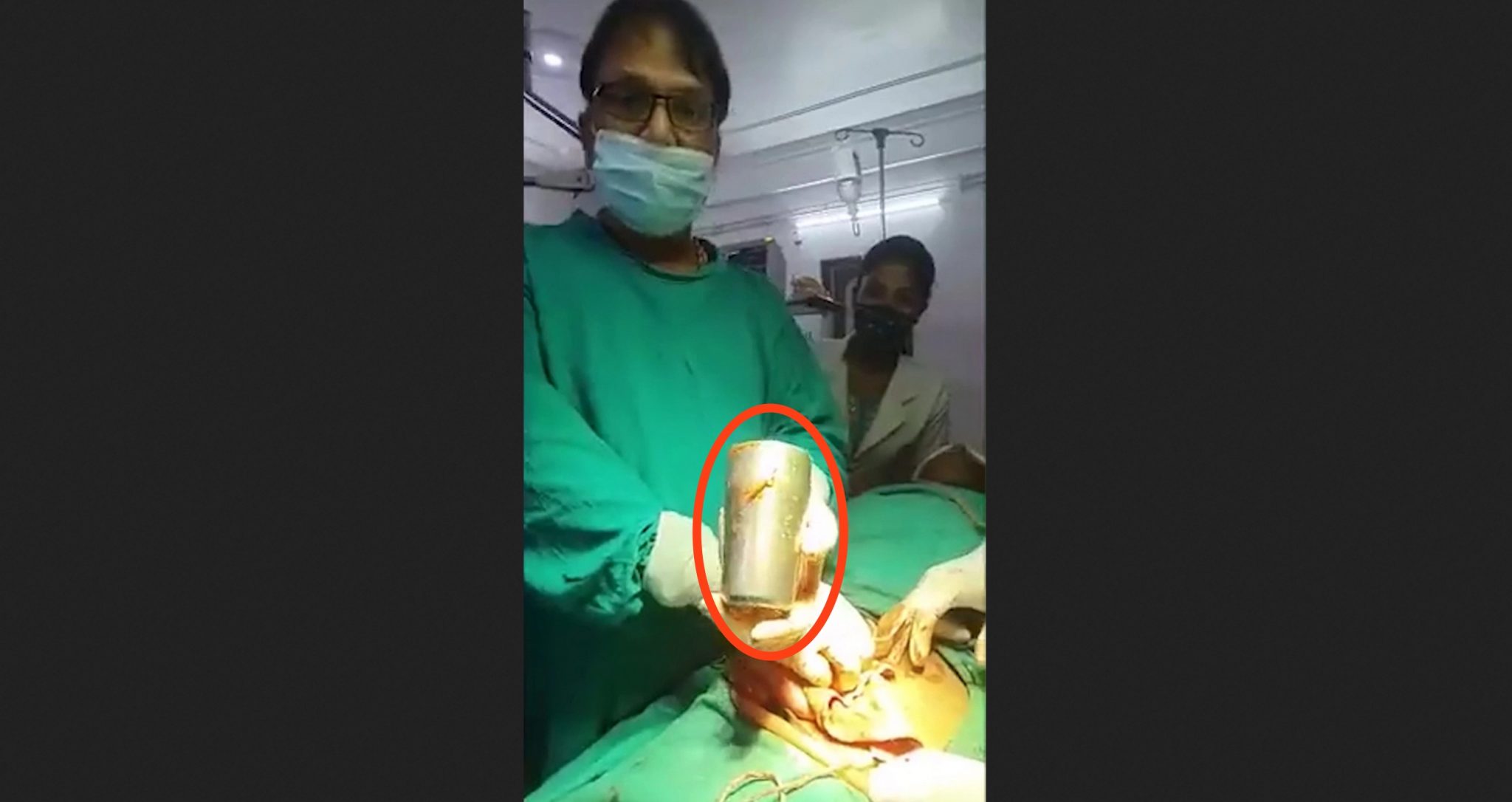 Doctors Remove Metal Cup From Indian Mans Stomach Watch Video Yardhype 5799