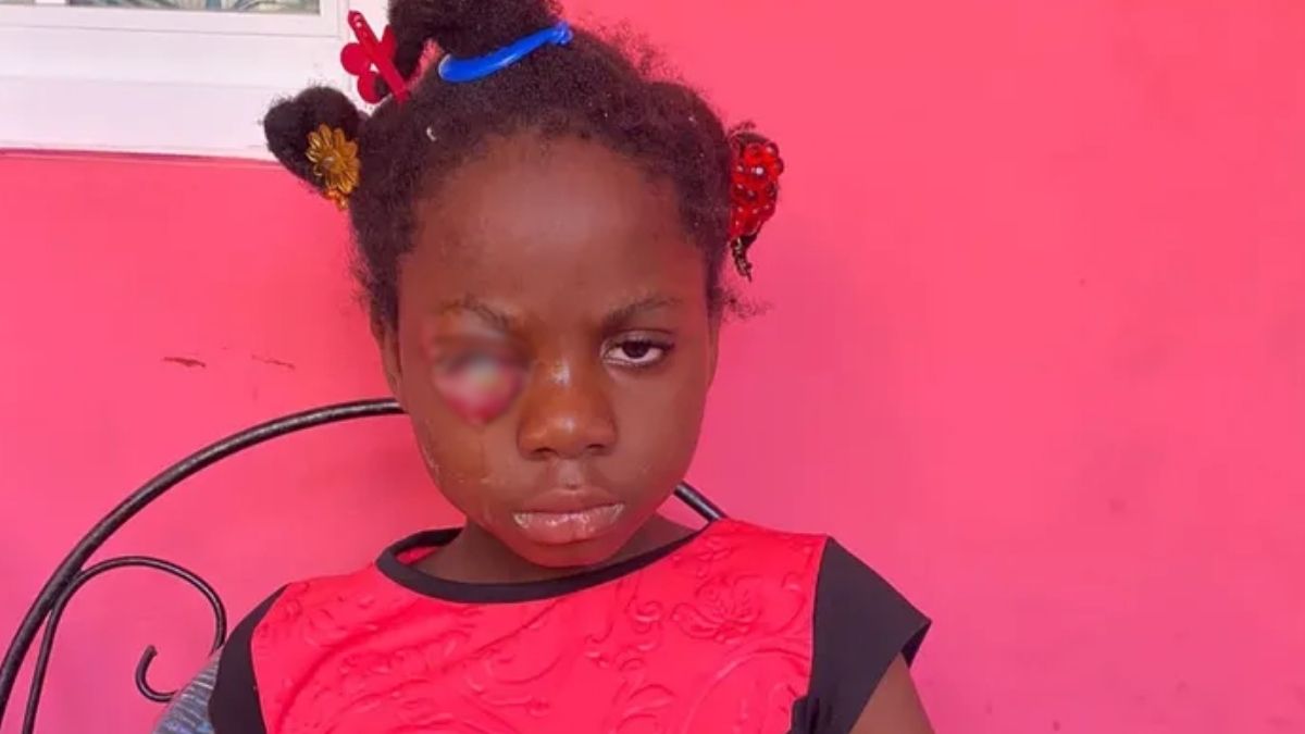 9-Y-O Loses Vision in Right Eye Due to Cancer: Eye Now in Horrible State: GoFundMe Launched