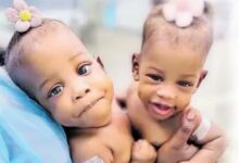 Conjoined Twins from St. Andrew Needs Help for Separation Surgery Which Costs US$4 Million