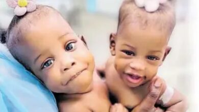 Conjoined Twins from St. Andrew Needs Help for Separation Surgery Which Costs US$4 Million