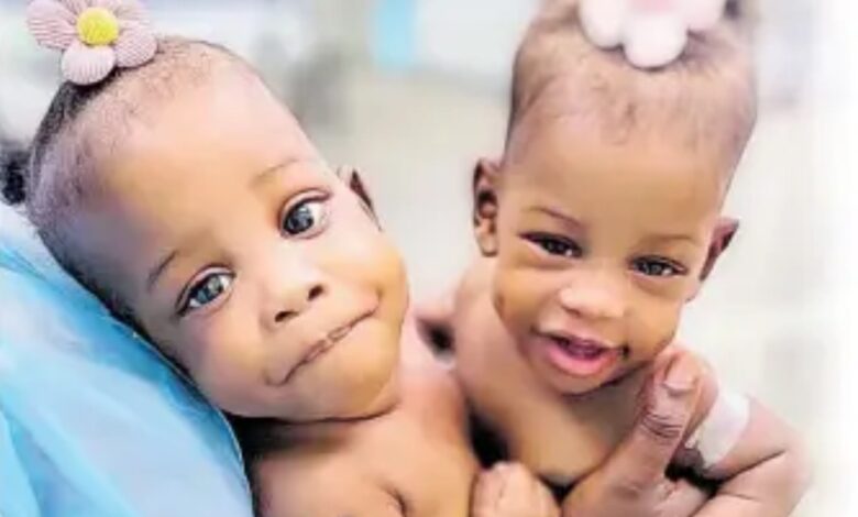 Conjoined Twins from St. Andrew Needs Help for Separation Surgery Which Costs US$4 Million